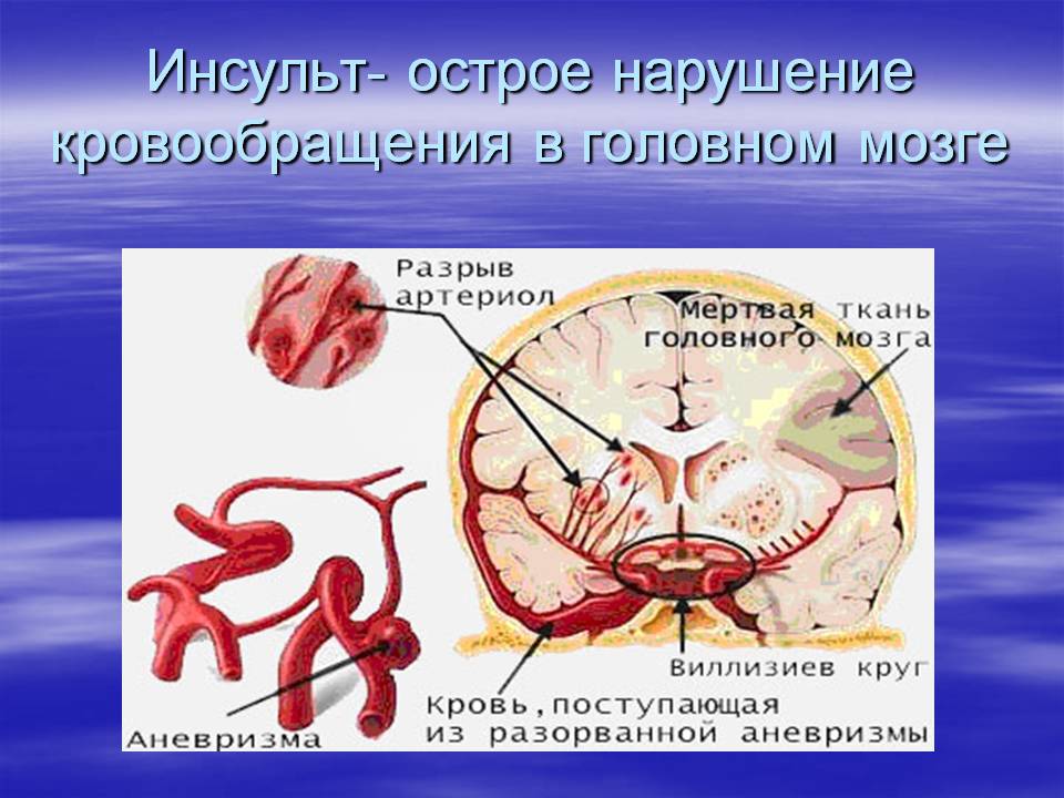 Инсульт картинка мозга